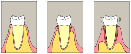 Paradontitis2