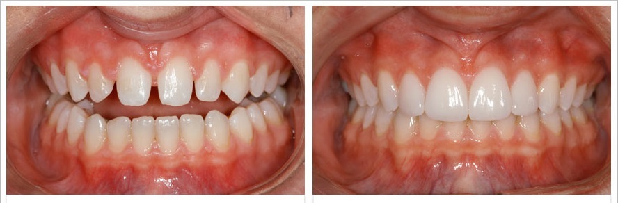 Porcelain_Veneers_2