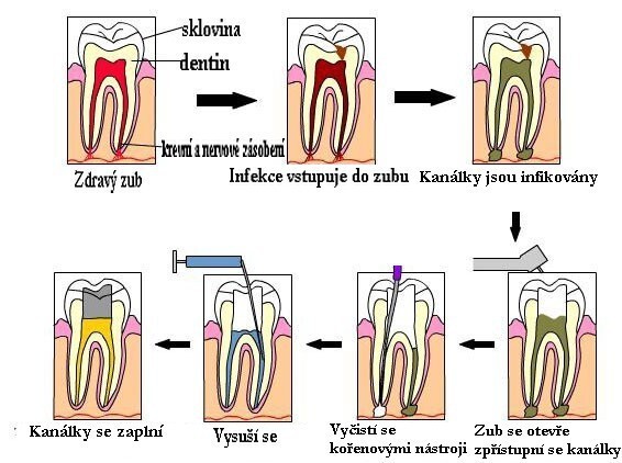 endo6