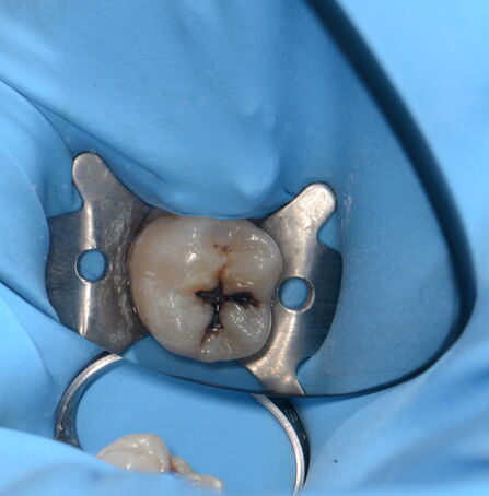 Zub před ošetřením