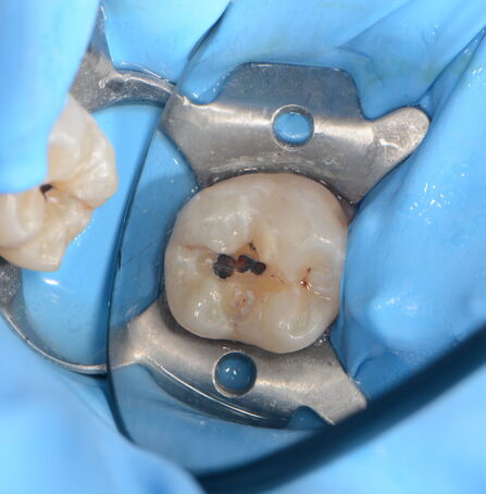 Během odvrtávání zubního kazu