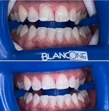 Bělení zubů BlancOne
