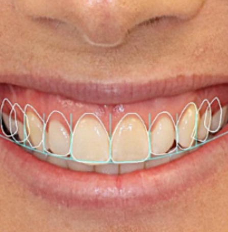 Digital Smile design