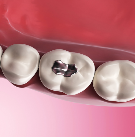 Vyměňte své staré výplně zubů